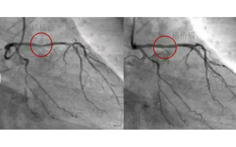 深圳市模具廠對心臟支架的關(guān)注，國產(chǎn)化的道路有多長？